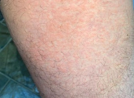 pv derm 4 | Walter Reeves: The Georgia Gardener